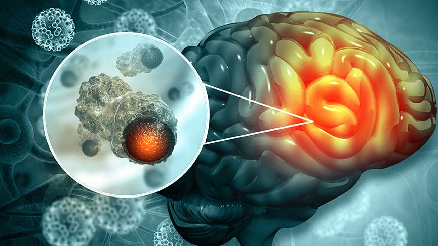 Brain Tumor Diagnosis and Treatment