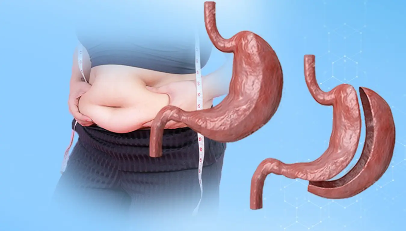 Gastric Sleeve surgery in Ankara, Turkey