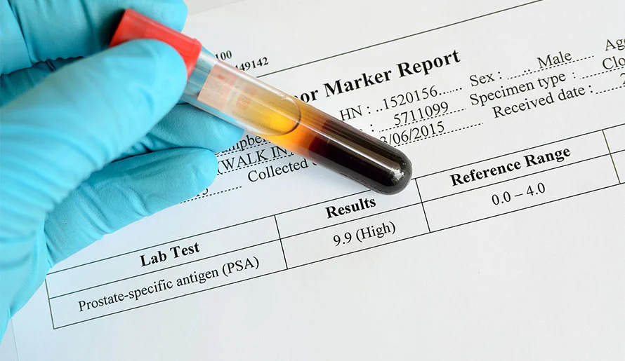 Prostate-Specific Antigen (PSA)